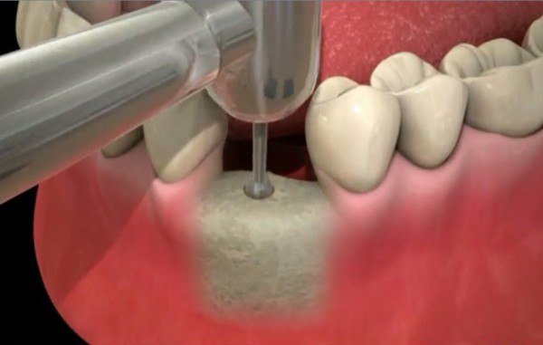 Pose d'implants dentaires par le Dr REMY Marie-Astrid à Paris 7