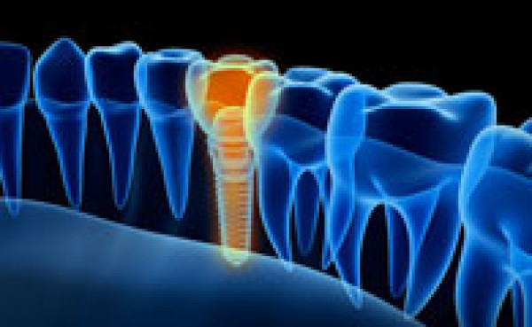 Qu'est-ce qu'un implant dentaire ? Indications et contre-indications par le Dr REMy Marie-Astrid à Paris 7